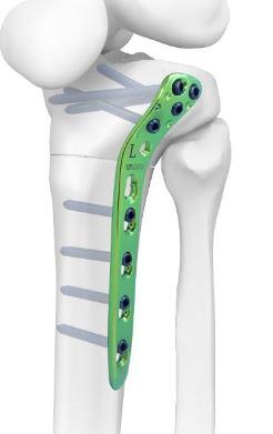 Проксимально-латеральна великогомілкова опорна пластина І, ліва ( Double Medical Technology Inc.)